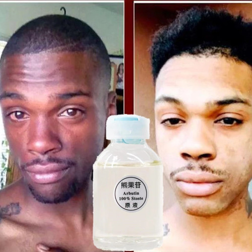 dark-skin-permanent-whitening-lightening-big-1